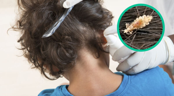 Tres Remedios Efectivos para Eliminar los Piojos en Niños y Adultos