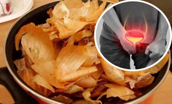 Remedios Caseros de Cebolla y Cáscara para la Vejiga y Próstata