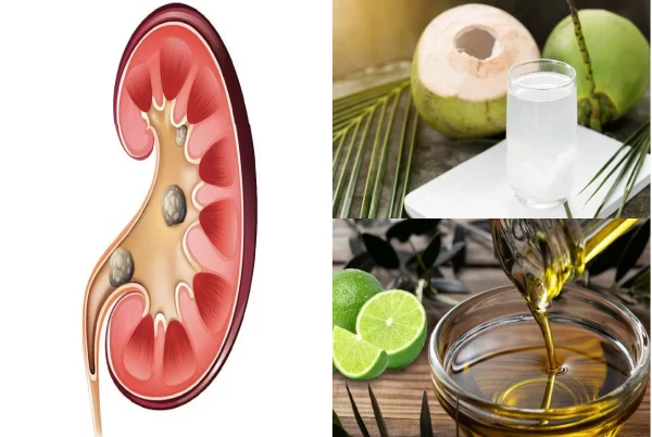 4 Remedios Naturales Efectivos para Eliminar Piedras en los Riñones y la Vesícula
