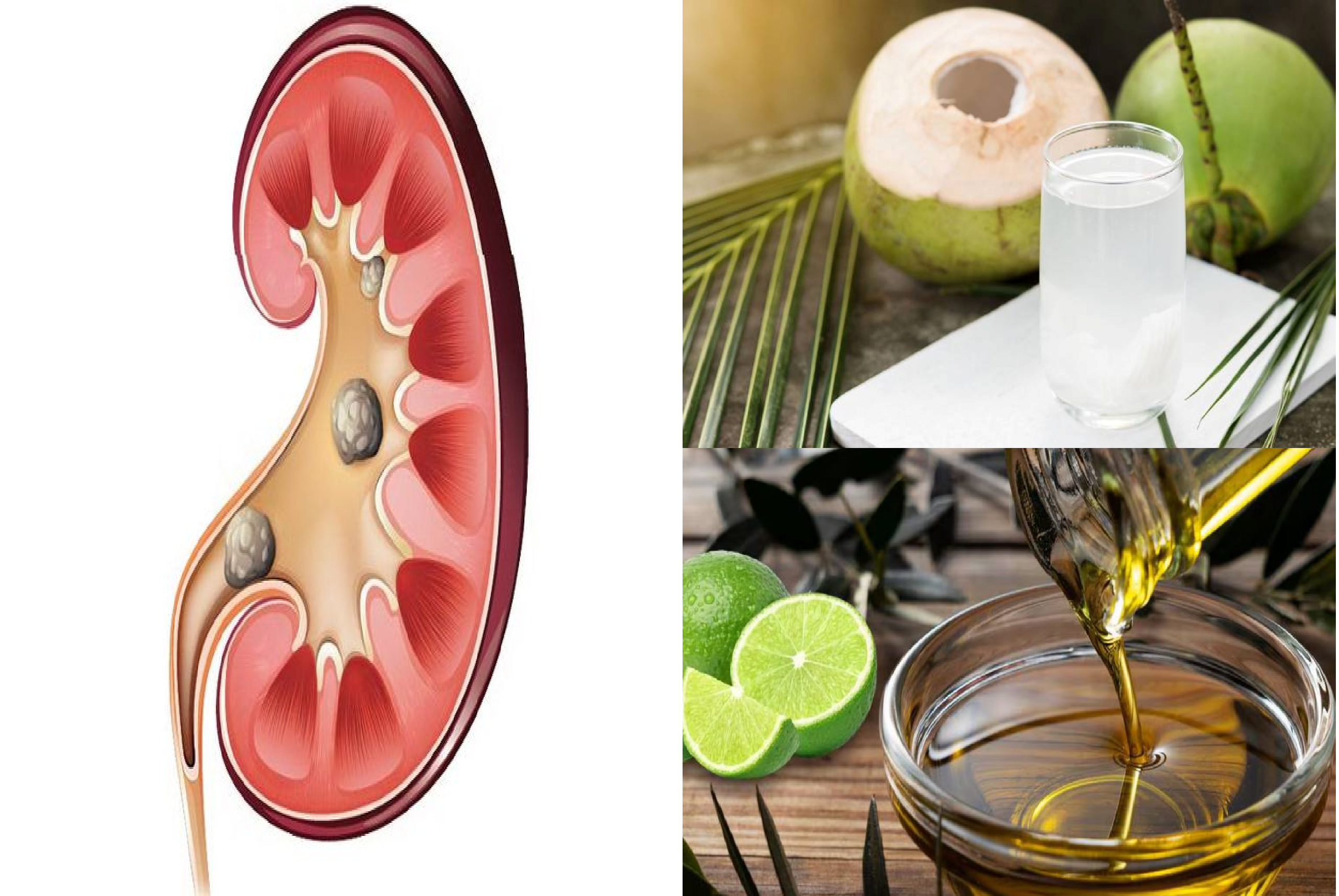 4 Remedios Naturales Efectivos para Eliminar Piedras en los Riñones y ...