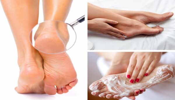 Tratamiento de pies agrietados y callos con aspirina: Una guía completa