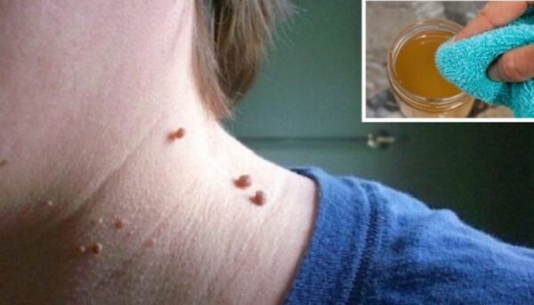 Guía Completa de Tratamientos Caseros para Eliminar Verrugas de Forma Natural