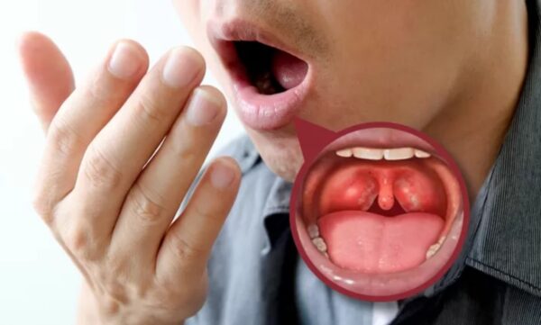 Tres Remedios Naturales Efectivos para Eliminar el Mal Aliento