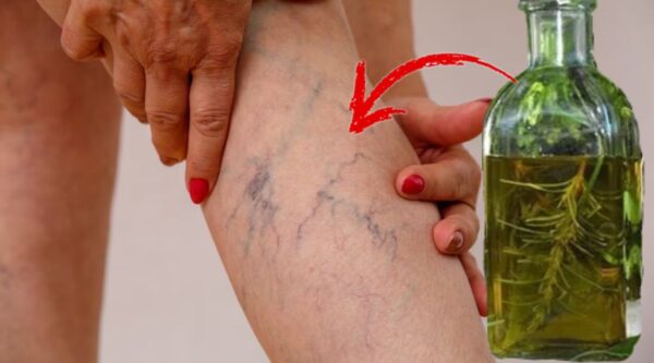 Beneficios del Alcohol de Romero para Aliviar el Dolor de las Varices