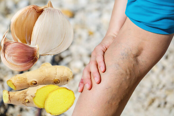 "Ajo y Jengibre para Várices: Remedio Natural Efectivo"
