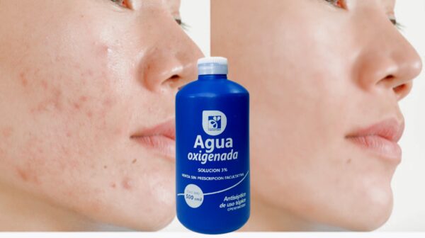 "Agua oxigenada para manchas y arrugas: Un remedio natural poderoso"