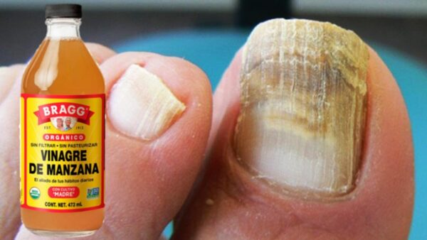 Cómo Usar el Vinagre de Manzana para Eliminar Hongos de las Uñas en 7 Días