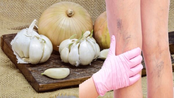 “Ajo y cebolla: el remedio natural más potente contra las varices”